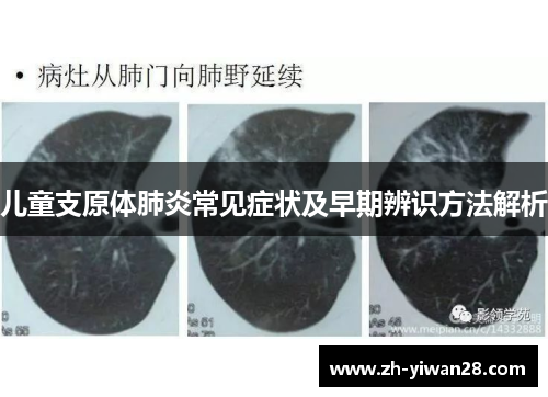 儿童支原体肺炎常见症状及早期辨识方法解析